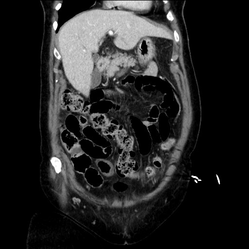 Closed loop small bowel obstruction due to adhesive bands - early and late images (Radiopaedia 83830-99014 B 40).jpg