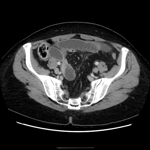 Closed loop small bowel obstruction due to adhesive bands - early and late images (Radiopaedia 83830-99015 A 128).jpg