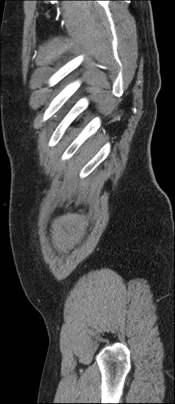 Coarctation of the aorta (Radiopaedia 74632-88521 C 310).jpg
