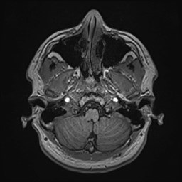 File:Cochlear incomplete partition type III associated with hypothalamic hamartoma (Radiopaedia 88756-105498 Axial T1 43).jpg