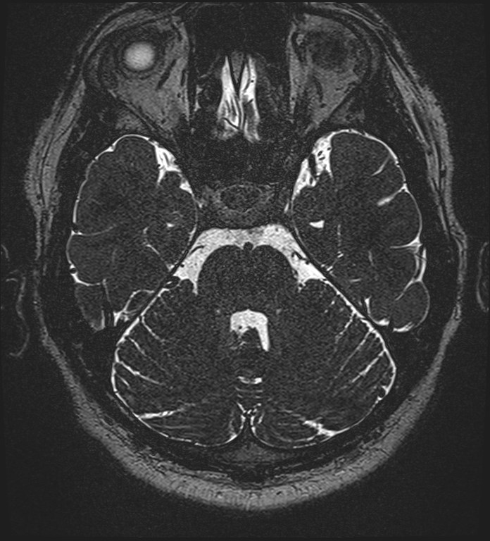 Cochlear incomplete partition type III associated with hypothalamic hamartoma (Radiopaedia 88756-105498 Axial T2 107).jpg