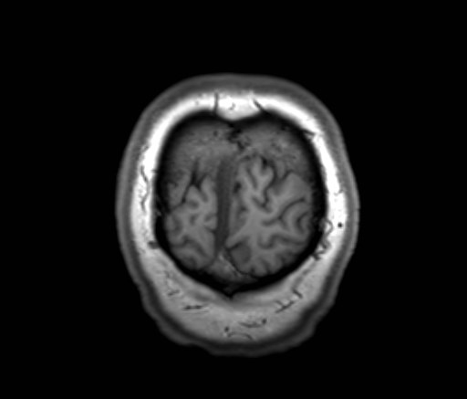 File:Cochlear incomplete partition type III associated with hypothalamic hamartoma (Radiopaedia 88756-105498 Coronal T1 7).jpg