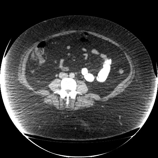 File:Collection due to leak after sleeve gastrectomy (Radiopaedia 55504-61972 A 48).jpg