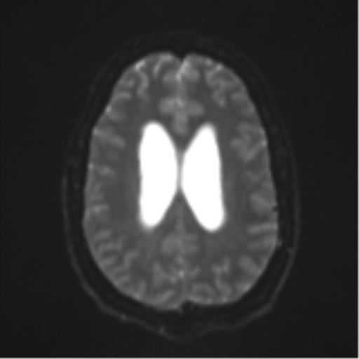Colloid cyst (Radiopaedia 44510-48181 Axial DWI 20).png