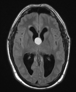 File:Colloid cyst (Radiopaedia 44510-48181 Axial FLAIR 14).png
