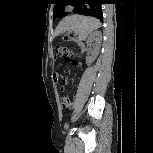 File:Colocutaneous fistula in Crohn's disease (Radiopaedia 29586-30093 F 2).jpg