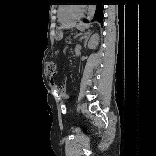 Colocutaneous fistula in Crohn's disease (Radiopaedia 29586-30093 F 26).jpg