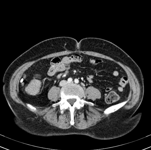 Colon carcinoma with hepatic metastases (Radiopaedia 29477-29961 A 69).jpg