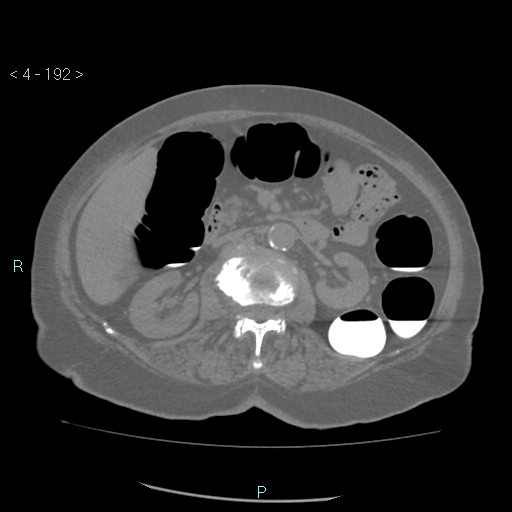 File:Colonic lipomas (Radiopaedia 49137-54244 Axial bone window 86).jpg