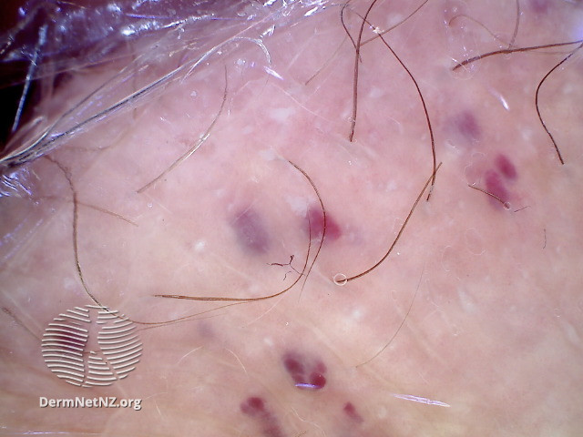 File:Dermoscopy of angiokeratoma of Fordyce on vulva (DermNet NZ angiokeratoma-48).jpg