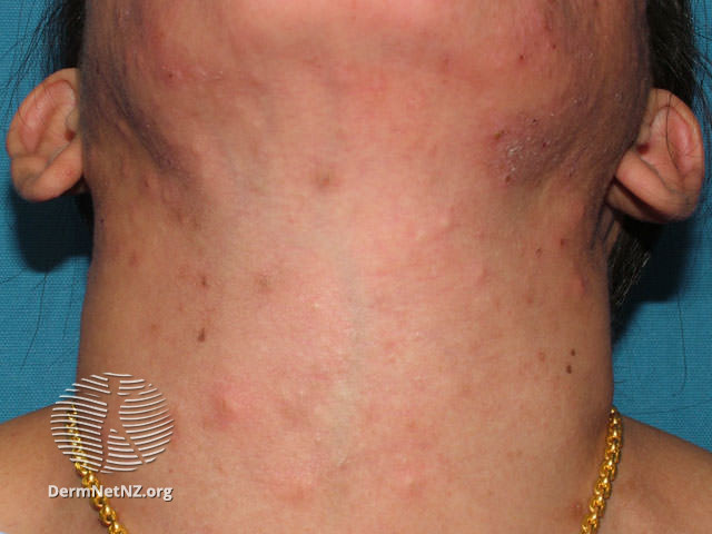 File:Eosinophilic folliculitis (DermNet NZ acne-eos-folliculitis1).jpg