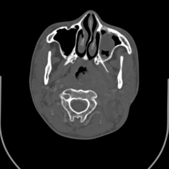 Nasopharyngeal carcinoma with skull base invasion (Radiopaedia 53415-59705 Axial bone window 64).jpg