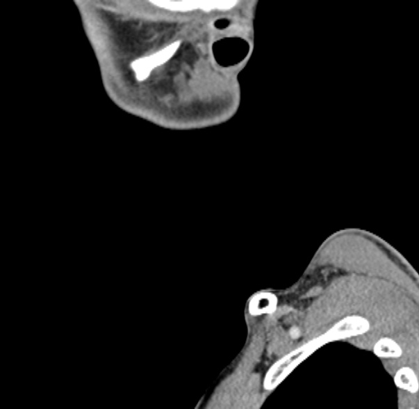 Nasopharyngeal carcinoma with skull base invasion (Radiopaedia 53415-59705 C 71).jpg