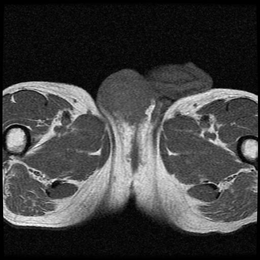 File:Necrotizing epididymo-orchitis with intra-testicular abscess (Radiopaedia 29397-29860 Axial T1 12).jpg