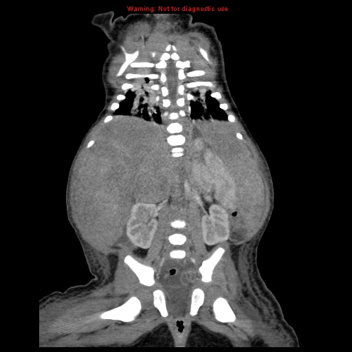 File:Neonatal neuroblastoma (Radiopaedia 9564-10223 B 88).jpg