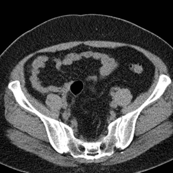 File:Nephrostomy for urosepsis (Radiopaedia 26180-26330 Axial non-contrast 50).jpg