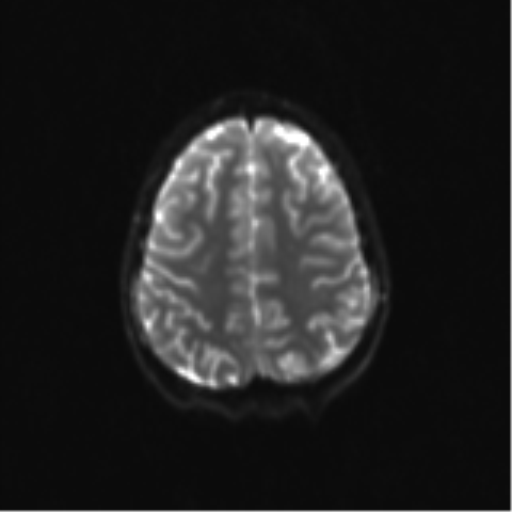 Neurenteric cyst (Radiopaedia 58641-65837 Axial DWI 28).png