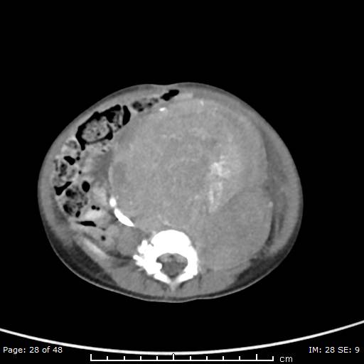 File:Neuroblastoma (Radiopaedia 41472-44355 A 28).jpg