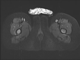 File:Neuroblastoma with bone metastases (Radiopaedia 67080-76414 Axial STIR 38).jpg