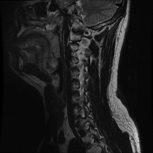 File:Neurofibromatosis type 2 (Radiopaedia 44936-48837 Sagittal T2 12).png