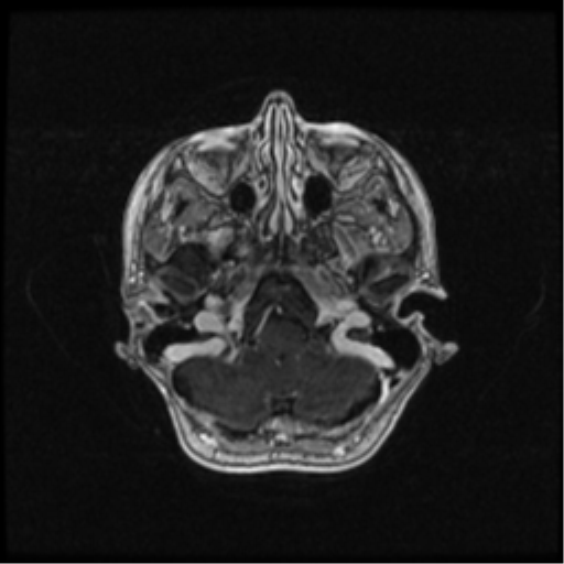 Neurofibromatosis type 2 (Radiopaedia 45229-49244 Axial T1 C+ 32).png