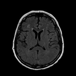 File:Neurofibromatosis type 2 (Radiopaedia 8713-9518 Axial FLAIR 11).jpg