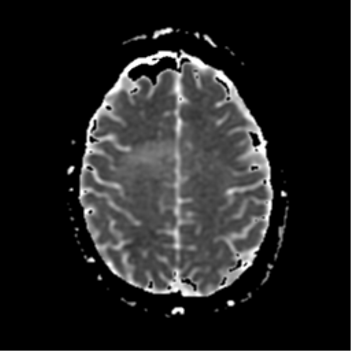 File:Neurofibromatosis type 2 - bilateral acoustic neuromata (Radiopaedia 40060-42566 Axial ADC 16).png