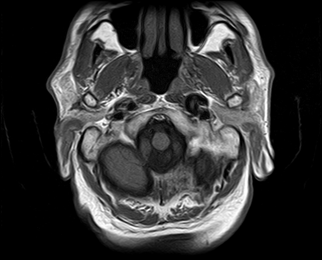 File:Non-Hodgkin lymphoma - parotid gland (Radiopaedia 71531-81890 Axial T1 18).jpg