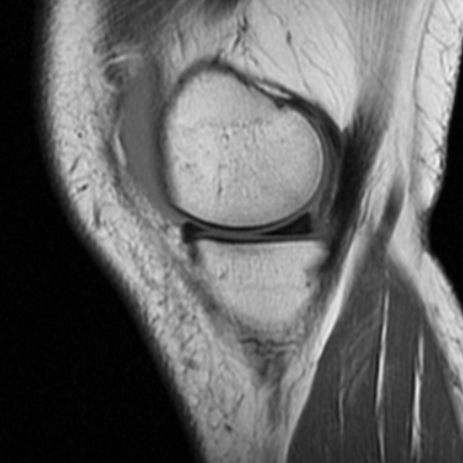 File:Non-displaced patella fracture (Radiopaedia 15932-15582 Sagittal T1 4).jpg