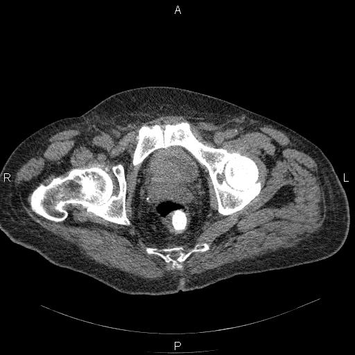 File:Non Hodgkin lymphoma in a patient with ankylosing spondylitis (Radiopaedia 84323-99624 Axial non-contrast 63).jpg