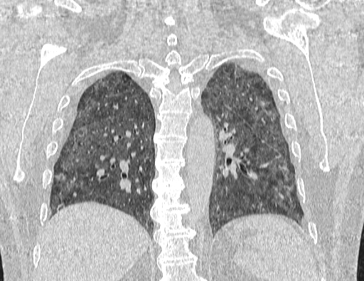 Non specific interstitial pneumonia (NSIP) (Radiopaedia 89725-106798 Coronal lung window 54).jpg