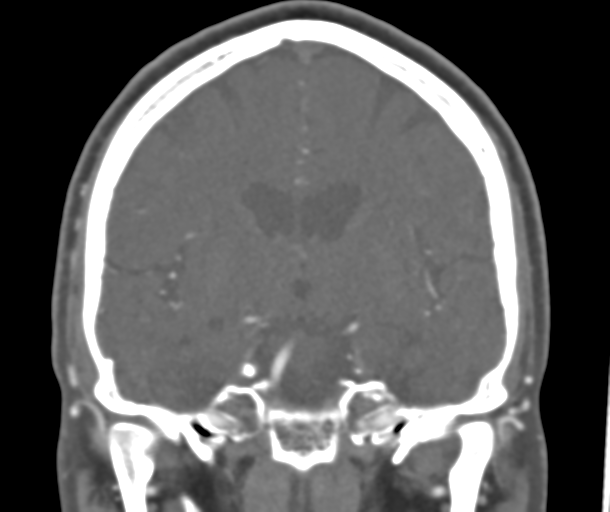 File:Normal CTA head (Radiopaedia 40801-43464 B 51).png