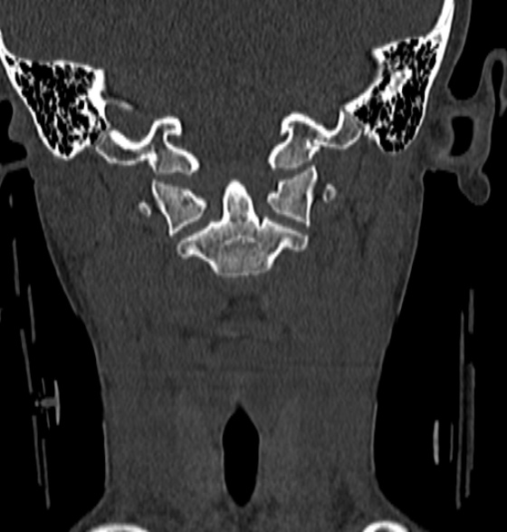 File:Normal CT cervical spine - 12-year-old (Radiopaedia 55352-61775 Coronal bone window 62).jpg