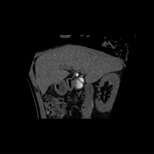 File:Normal CT intravenous cholangiogram (Radiopaedia 38199-40208 Axial IVC (MIP) 98).png