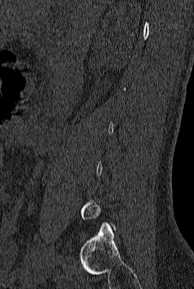 File:Normal CT lumbar spine (Radiopaedia 53981-60118 Sagittal bone window 1).jpg