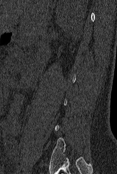 File:Normal CT lumbar spine (Radiopaedia 53981-60118 Sagittal bone window 82).jpg
