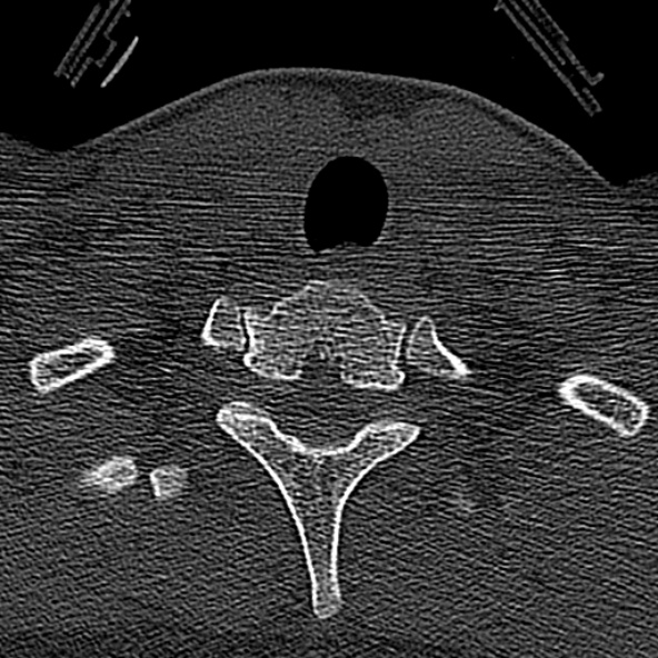 Normal CT of the cervical spine (Radiopaedia 53322-59305 Axial bone window 237).jpg