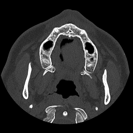 Normal CT paranasal sinuses (Radiopaedia 42286-45390 Axial bone window 97).jpg
