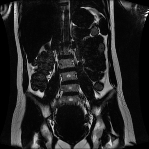 Normal MRI abdomen in pregnancy (Radiopaedia 88001-104541 N 83).jpg