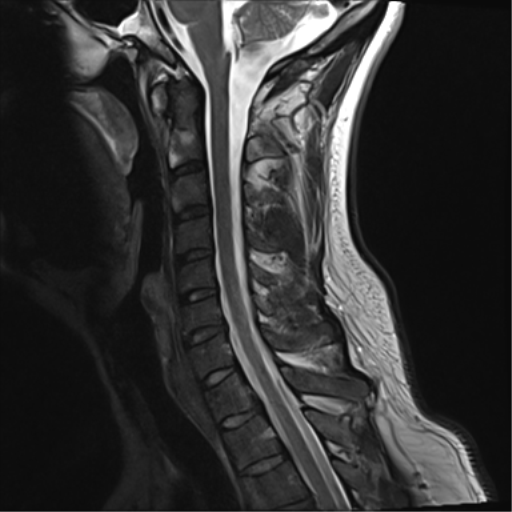 File:Normal MRI cervical spine (infection protocol) (Radiopaedia 53916-60039 Sagittal T2 9).png