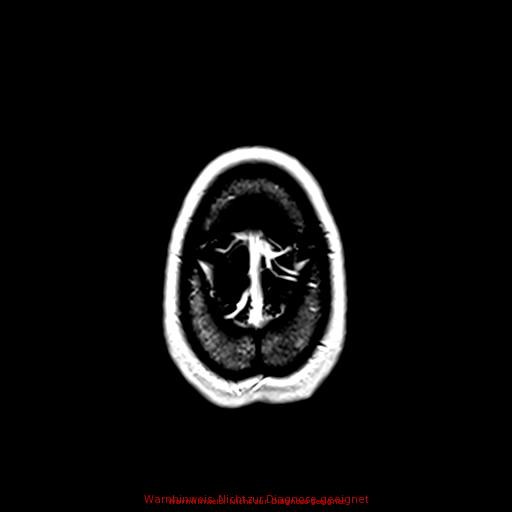 Normal adult brain MRI (non-enhanced and contrast-enhanced) (Radiopaedia 75262-86379 Axial T1 C+ 169).jpg