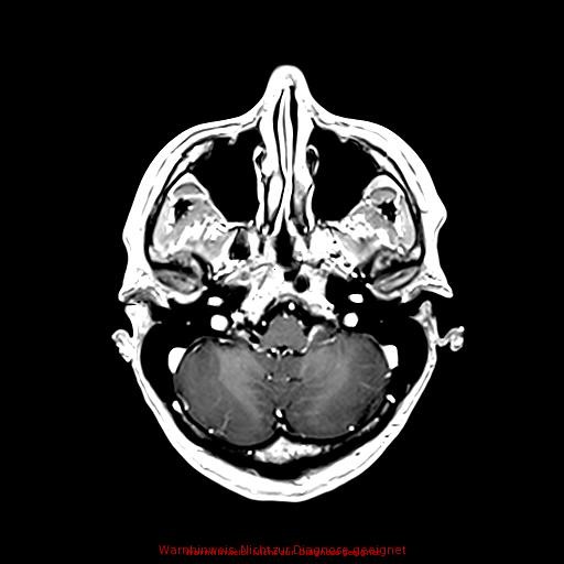 Normal adult brain MRI (non-enhanced and contrast-enhanced) (Radiopaedia 75262-86379 Axial T1 C+ 60).jpg