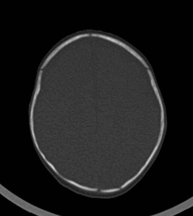 Normal brain CT - 2-month-old (Radiopaedia 53369-59350 Axial bone window 17).jpg