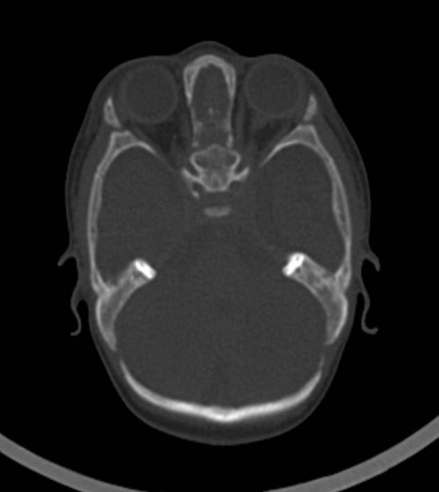 Normal brain CT - 2-month-old (Radiopaedia 53369-59350 Axial bone window 45).jpg