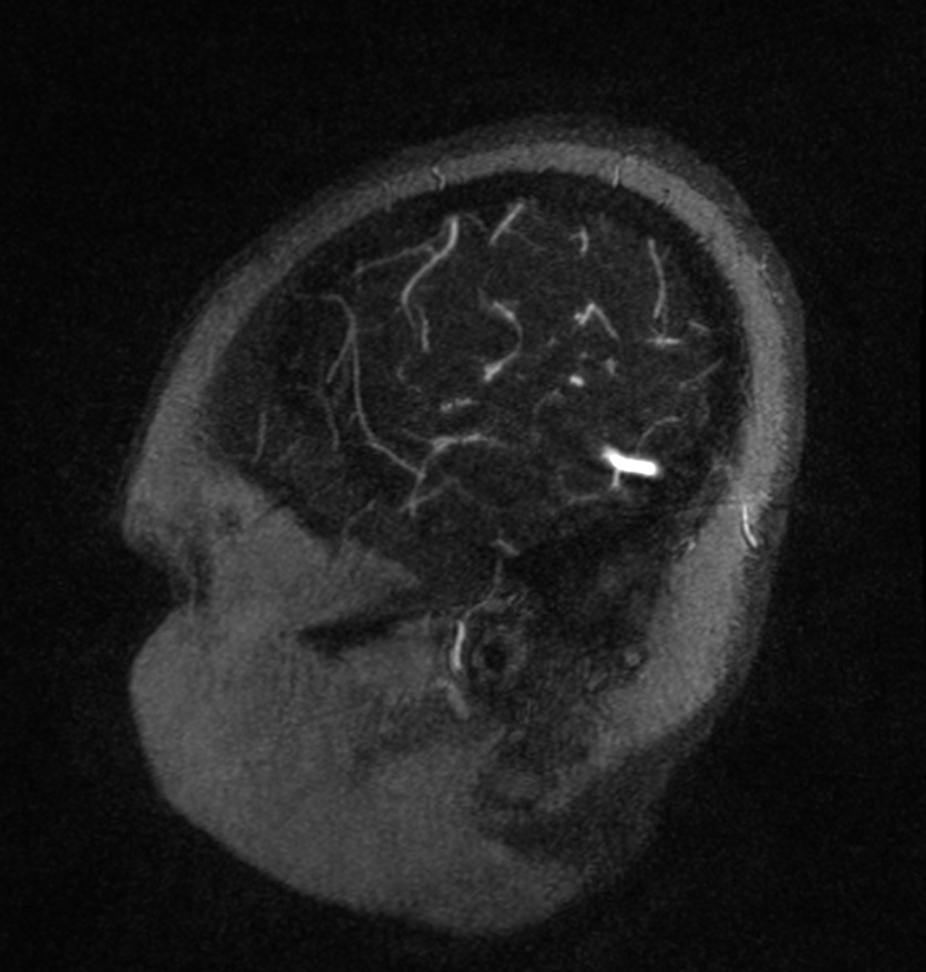 Normal brain MRI and venogram (Radiopaedia 39554-41862 Sagittal MRV 5).jpg