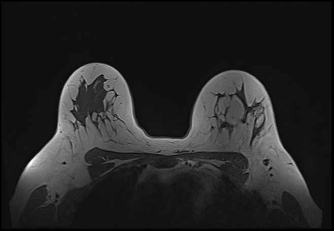File:Normal breast MRI - dense breasts (Radiopaedia 80454-93850 Axial T1 154).jpg