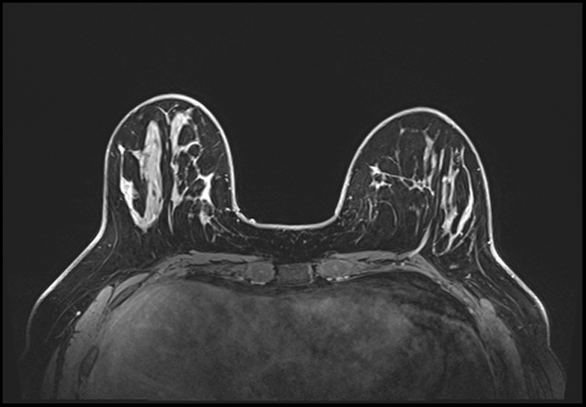 Normal breast MRI - dense breasts (Radiopaedia 80454-93850 C 69).jpg