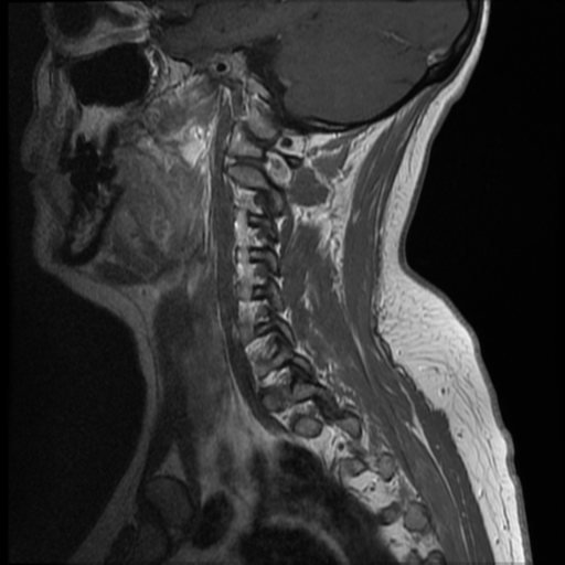 File:Normal cervical and thoracic spine MRI (Radiopaedia 35630-37156 Sagittal T1 C+ 2).png