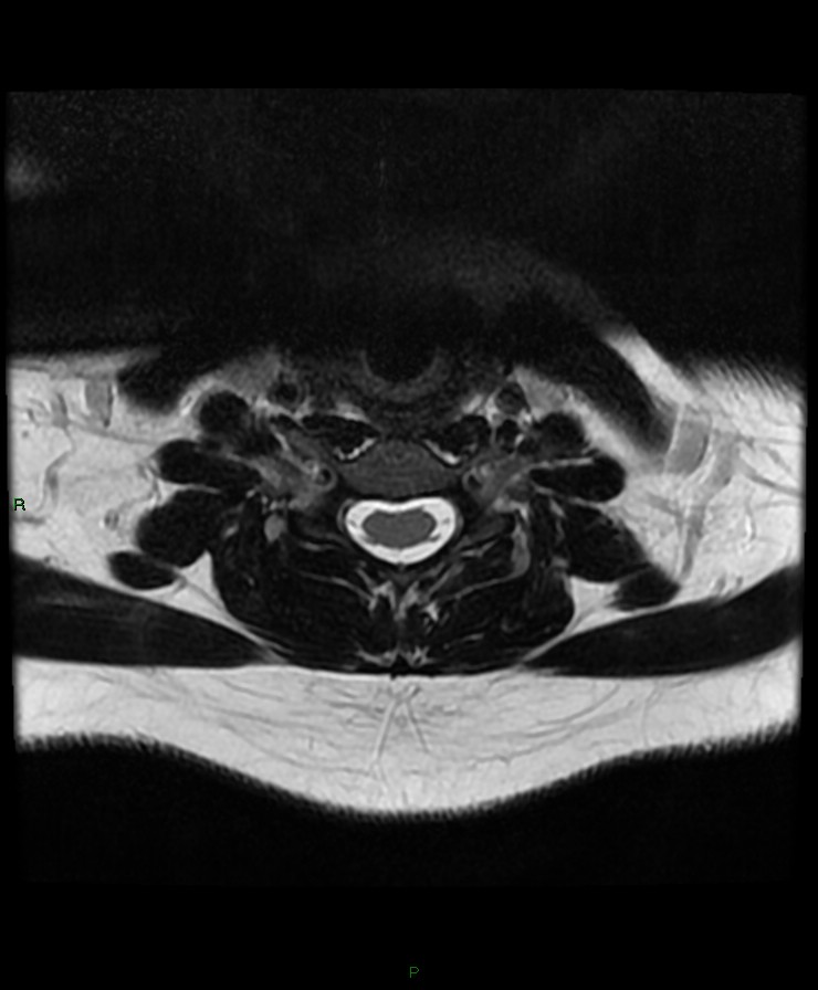 Normal cervical spine MRI (Radiopaedia 80146-93454 Axial T2 65).jpg