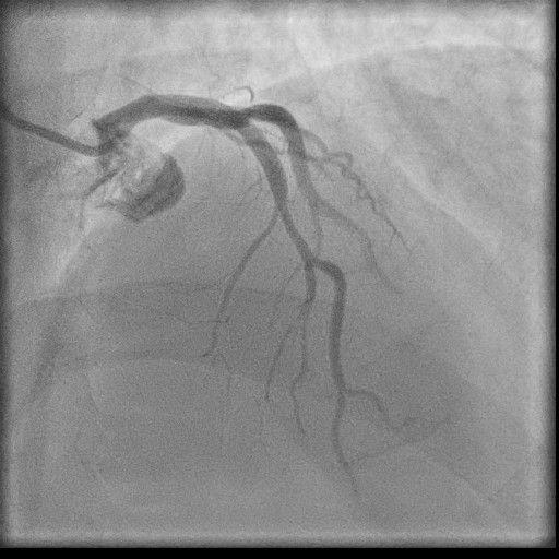 Normal coronary angiogram (DSA) (Radiopaedia 63081-71571 E 26).jpg
